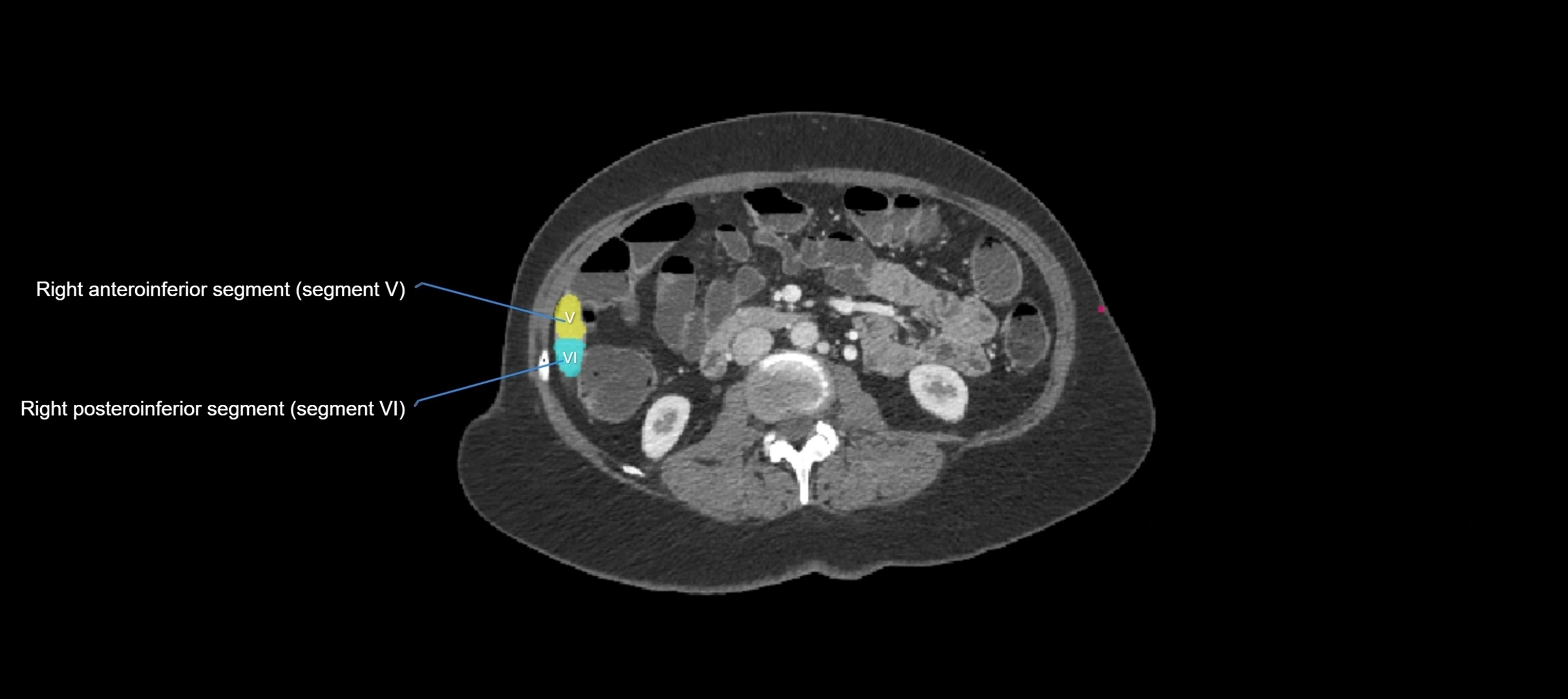 CT liver segments axial cross sectional anatomy labelled image-00005.webp